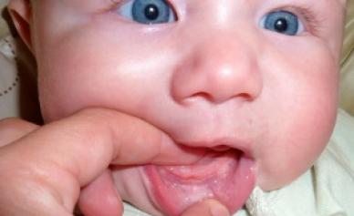 Symptome und Behandlung von Gingivitis im Kindesalter Gingivitis bei einem 1-jährigen Kind
